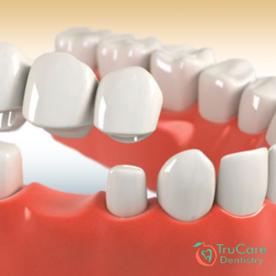 All You Should Know About Dental Crown and Procedures