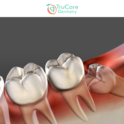 Causes & Symptoms of Impacted Wisdom Teeth