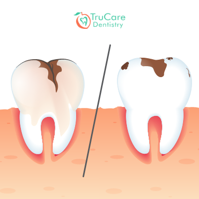 Cavity vs. Stain: Everything You Should Know – TruCare Dentistry