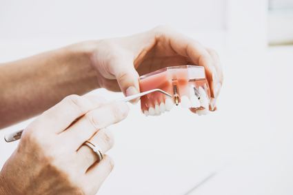 What’s Better?  Saving Your Natural Tooth or Getting A Dental Implant?