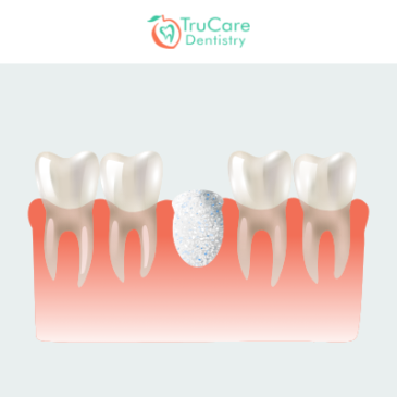 How Dental Bone Graft Surgery Helps Create A Strong Base For Implants?