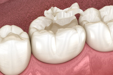 Here’s Everything About Inlays And Onlays In Dental Work