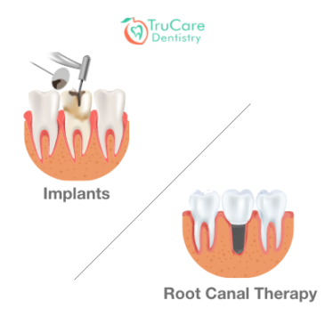 Which Is the Safest and Quickest Treatment Between Implants and Root Canal Therapy?