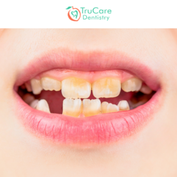 What are white spot lesions on teeth? Do they need immediate treatment?