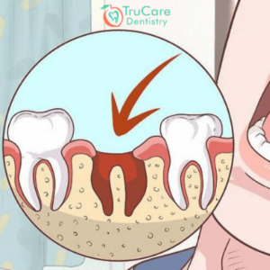 Painful Dry Sockets Post Tooth Extraction and How to Handle the Pain ...