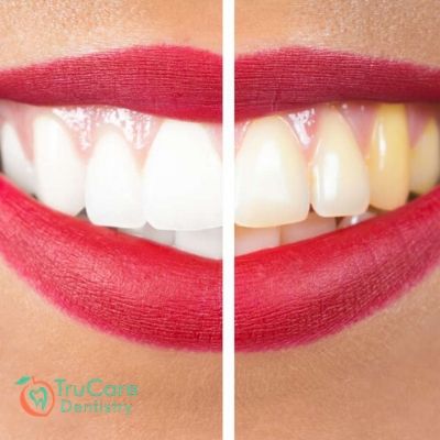Pale Gums: A Serious Oral Health Condition and Its Key Causes – TruCare Dentistry Roswell
