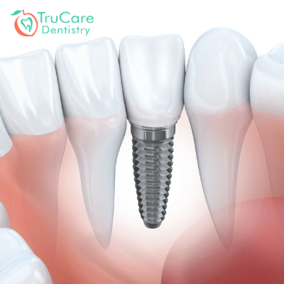 Dental implant vs root canal