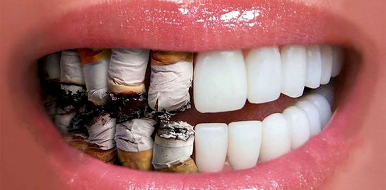 Smoking and Oral Health