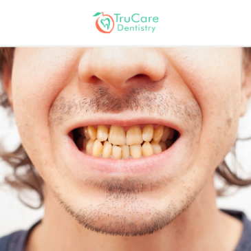 How Can You Deal with Tetracycline-Stained Teeth?