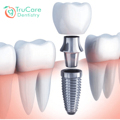 dental implants newport