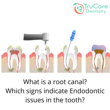 What is a root canal? Which signs indicate endodontic issues in the tooth?