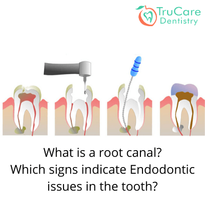 What is a root canal and endodontic issues