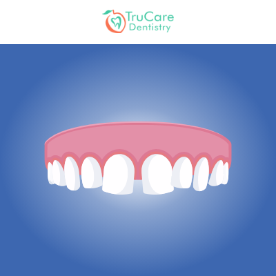 Resin bonding increases tooth length for short teeth