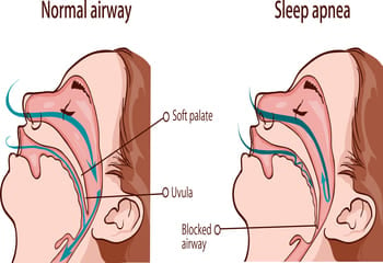 Apnea treatment sleep Beyond CPAP: