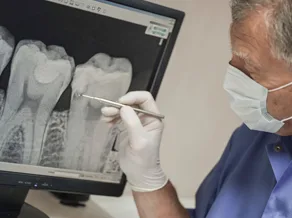 Root-Canal-Treatment