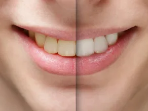 Teeth-Whitening