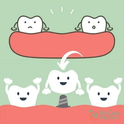 5 Best Options for Replacing Missing Teeth
