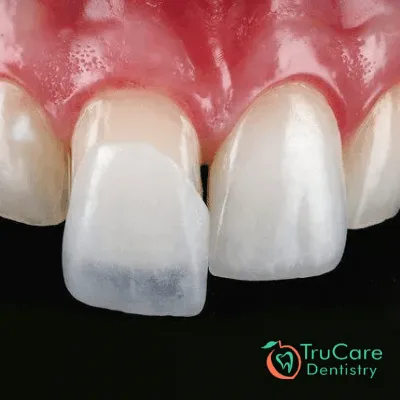 7 Important things to consider before getting dental veneers