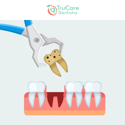 8 signs that indicate an emergency tooth extraction has become inevitable