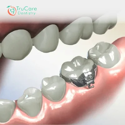 A Simple Guide To Know Everything About Molar Bands