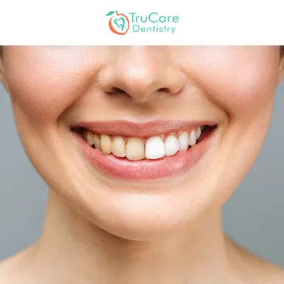 Using BEWE for the Screening of Erosive Tooth Wear
