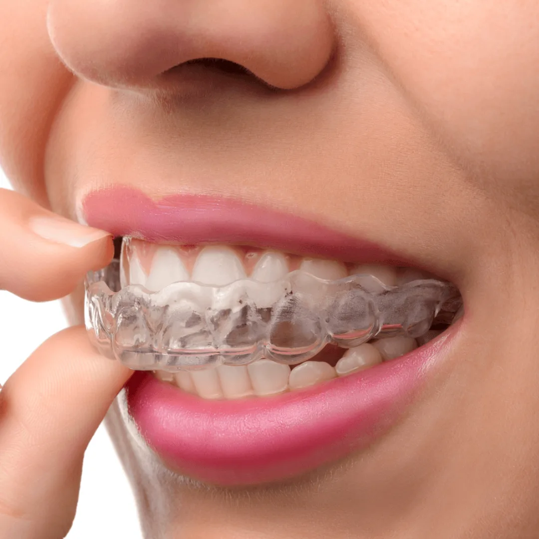 Advantages of Invisalign