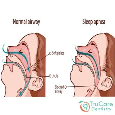 All You Need to Know About Sleep Apnea A Sleep Disorder