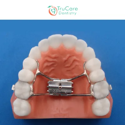All about Palate Expanders