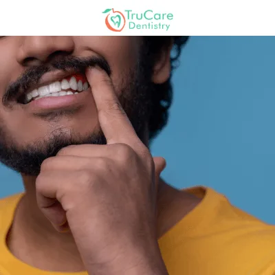 Causes and Treatments of Chipped Tooth