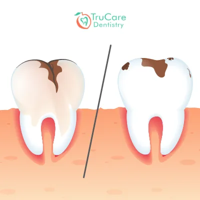 Cavity or stain