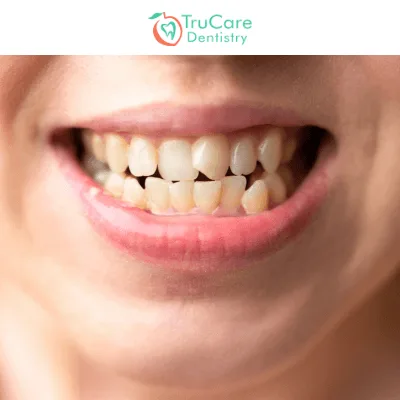 Crossbite Understanding Its Impact and Cosmetic Dentistry Solutions