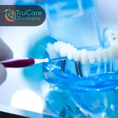 Dental Implant Clean And Hygienic