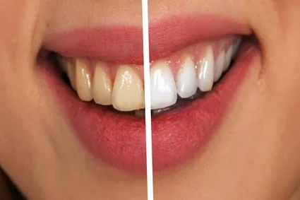 Dental_Tartar_trucare