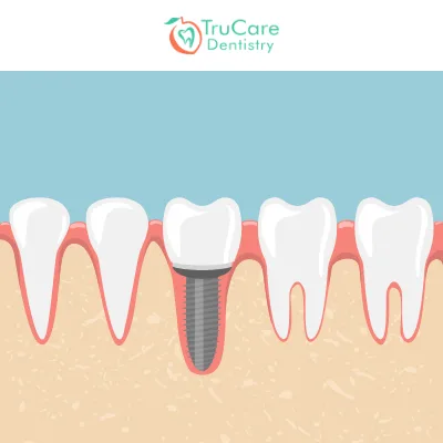 Dental implants