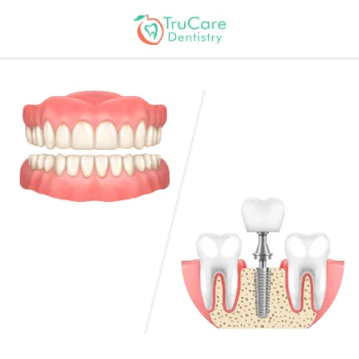 Dentures vs implants