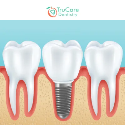 Dental Implants in Roswell & Marietta, Georgia
