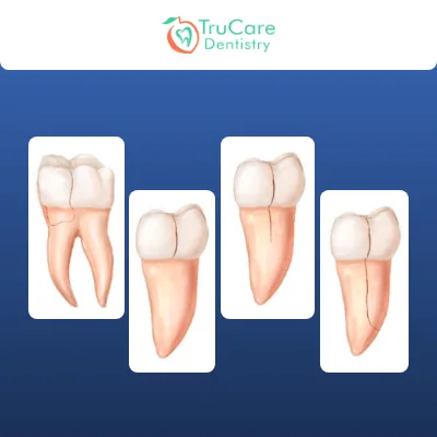 Everything about Cracked Teeth