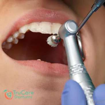 Everything that you need to know about Fluoride Treatment