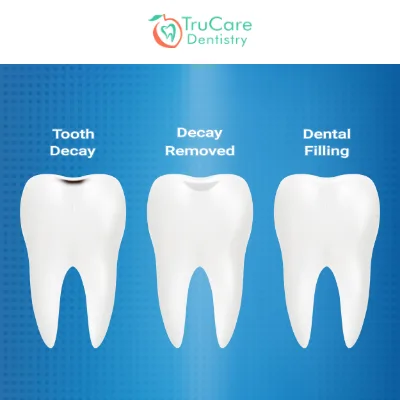 Fillings Look Like Your Natural Teeth