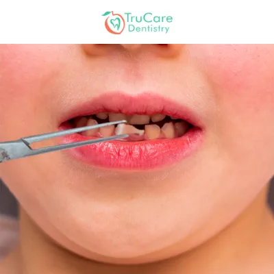 Guide about Baby Tooth Extraction Procedure