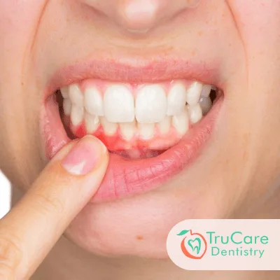 Gum Disease Treatment