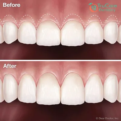 Gum Surgery Types and What to expect