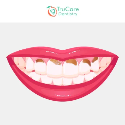 Gum line cavity