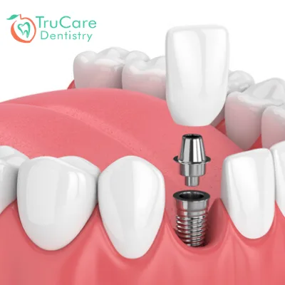 Here’s a step by step guide for the dental implants procedure