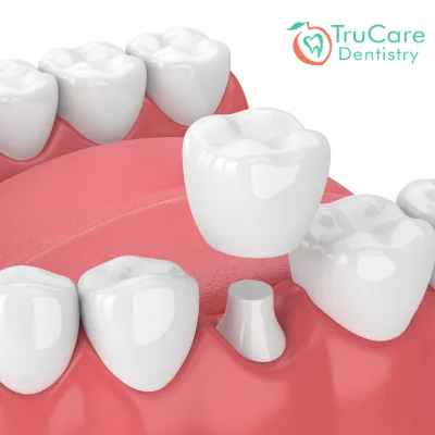 Here’s everything about the dental crown placement procedure