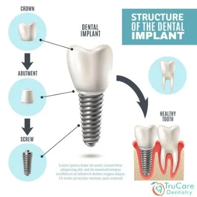 Here’s everything crucial that you need to know about dental crowns and bridges