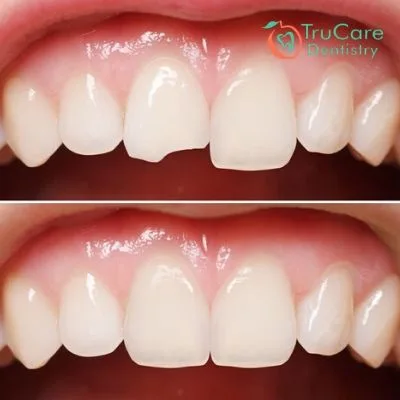 Here’s how dental bonding at TruCare Dentistry proves better than dark tooth fillings