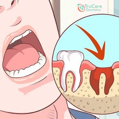 How Dentistry is Benefiting With PRP and PRF Processes?