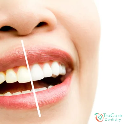 How Does Teeth Whitening Work