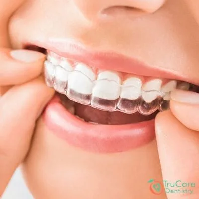 How to Straighten Your Teeth_ 3 Proven and Safe Methods